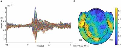 Localization of beta power decrease as measure for lateralization in pre-surgical language mapping with magnetoencephalography, compared with functional magnetic resonance imaging and validated by Wada test
